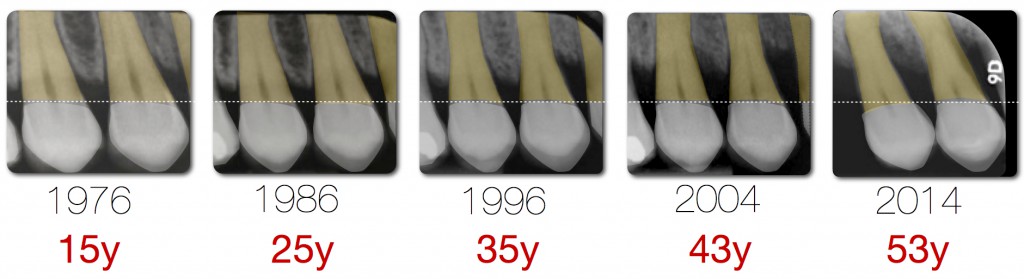 periodontitis bone loss.003.003